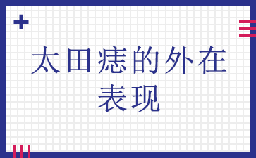 广州太田痣治疗-太田痣的外在表现